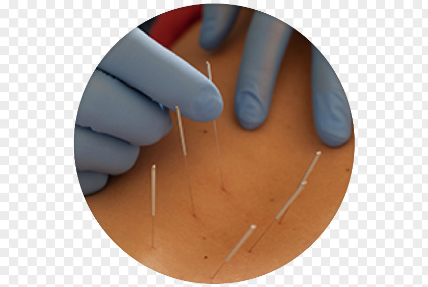 Acupuncture Needle Physical Therapy Manual Clinic PNG