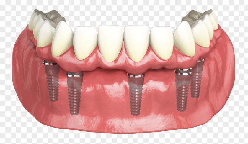 Hybridge Dental Implants Dentistry PNG