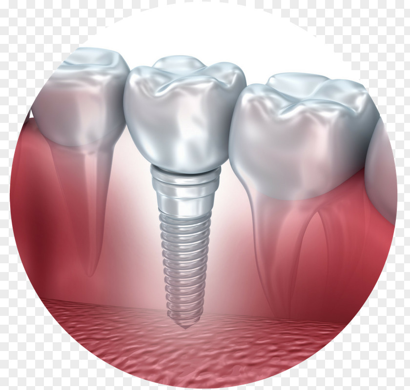 Dental Implant Dentist Tooth Surgery PNG