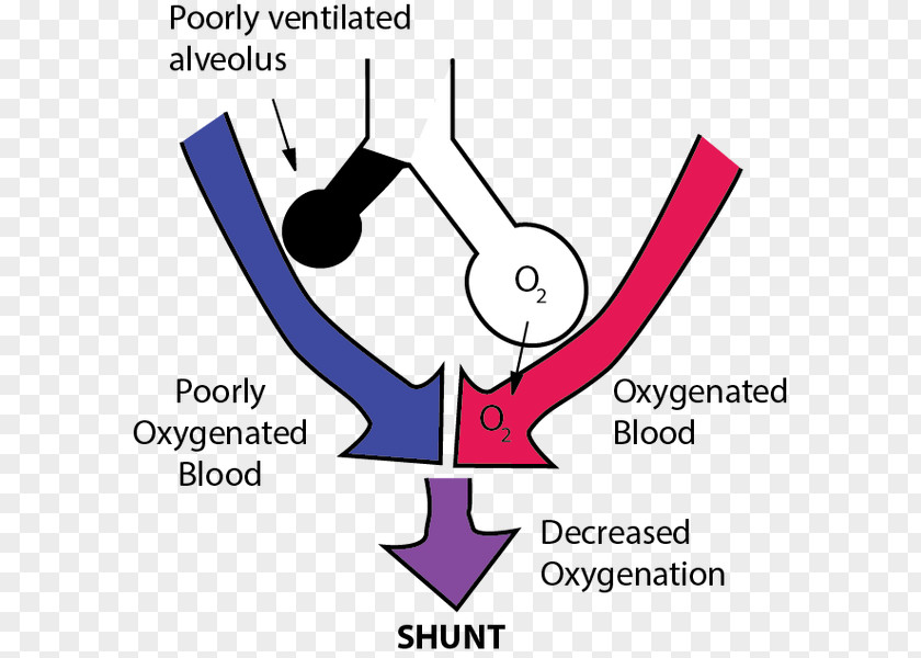 Anesthesiologist Pictogram Pulmonary Shunt Lung Ventilation/perfusion Ratio Ventilation Perfusion Mismatch PNG