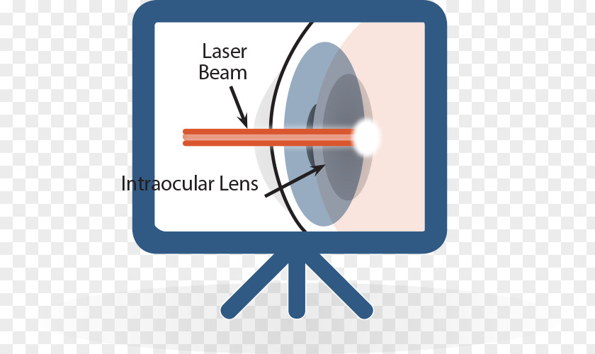 Laser Beam Cataract Surgery Lens PNG
