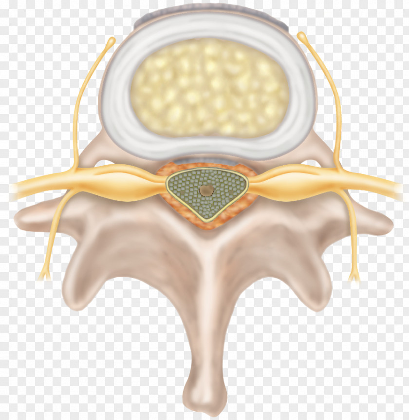 Degenerate Spinal Disc Herniation Intervertebral Degenerative Disease Cervical Vertebrae Neck Pain PNG