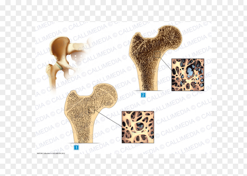 Osteoporosis Hip Rheumatology Illustration Anatomique Osteoarthritis PNG