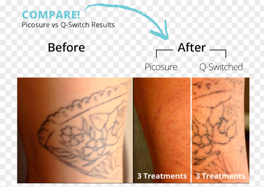 Tattoo Removal Détatouage Laser Q-switching PNG