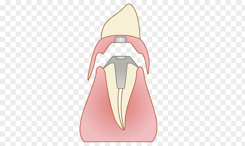 Bridge ふれあいファミリー歯科 Dentist Tooth Dental Implant PNG