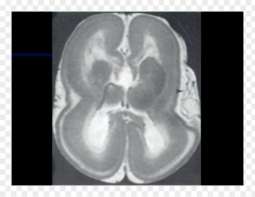 Brain Computed Tomography Radiology Magnetic Resonance Imaging Lääketieteellinen Röntgenkuvaus PNG