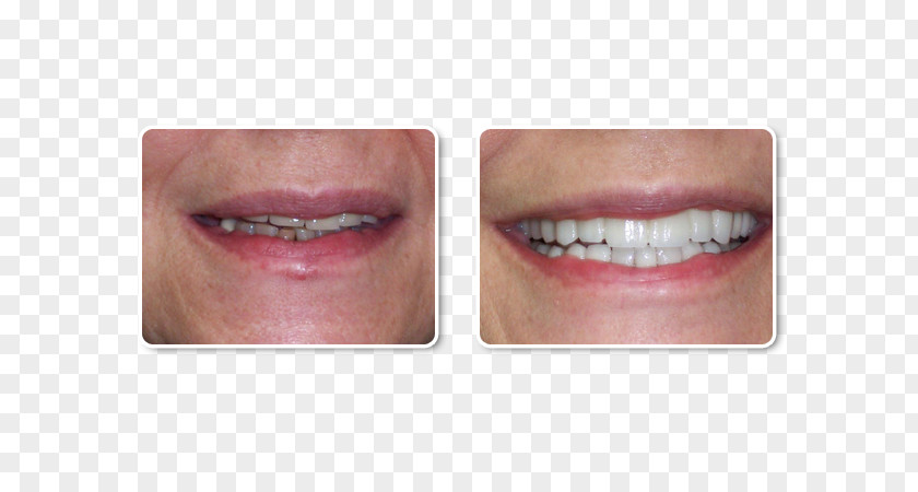 Cosmetic Dentistry Crown Tooth PNG