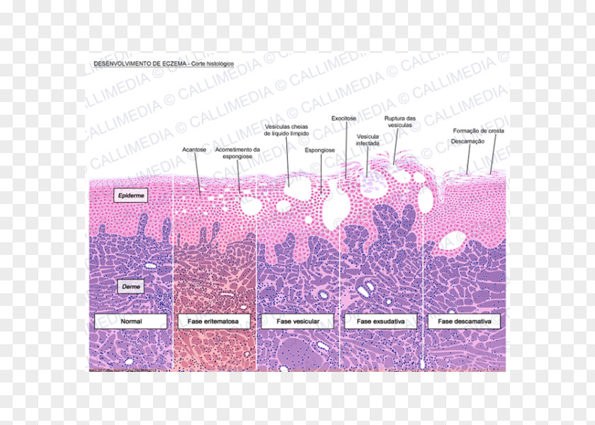 Eqzema Histology Dermatitis Keratinocyte Microscope Slides Corte Histológico PNG