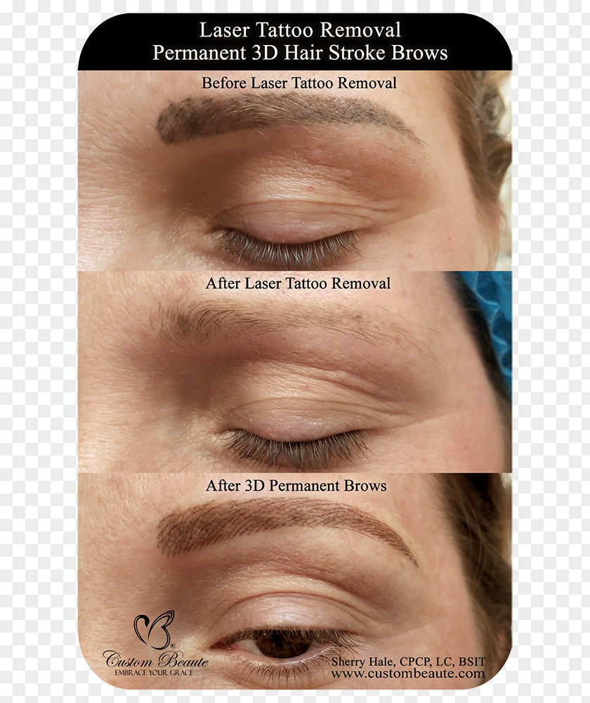 Hair Eyebrow Tattoo Removal Permanent Makeup Laser PNG