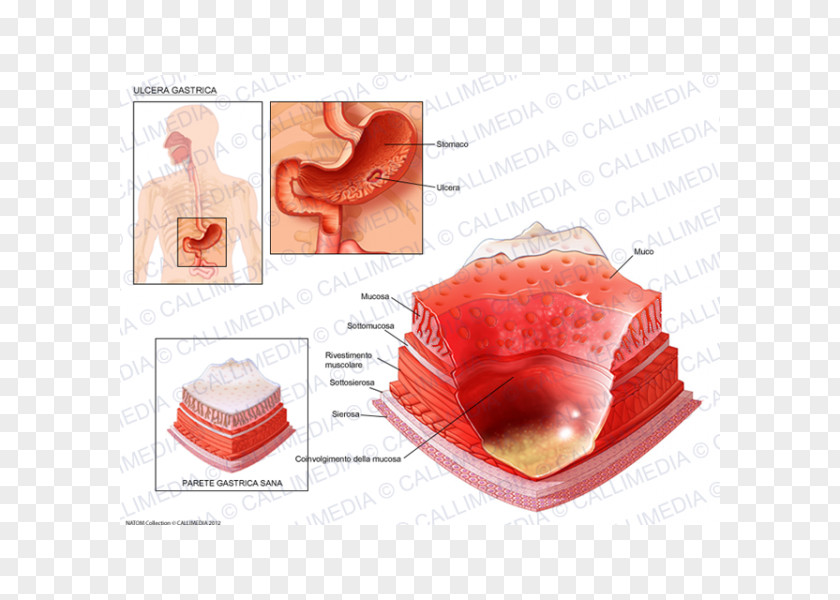 Ulcer Skin Peptic Disease Gastric Erosion Gastritis PNG