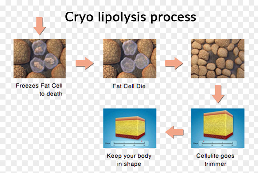 Cryolipolysis Liposuction Adipose Tissue Cellulite PNG