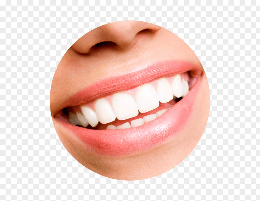 Tooth Whitening Cosmetic Dentistry Veneer PNG