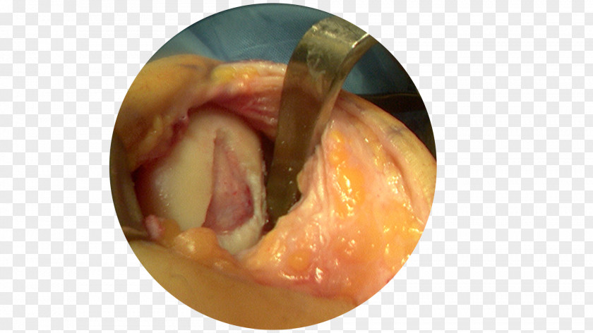 Arthrotomy Microfracture Surgery Arthroscopy Articular Cartilage Damage PNG