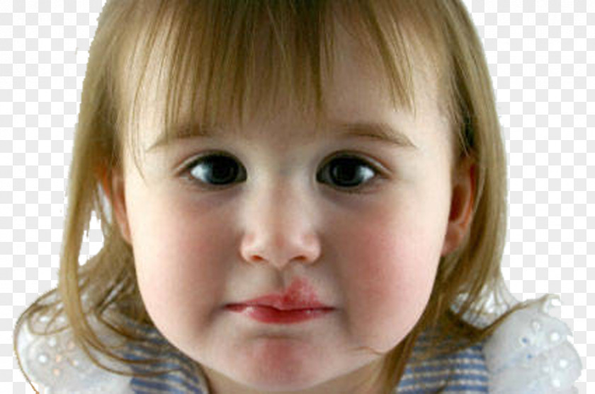 Childhood Chickenpox Herpes Labialis Canker Sore Skin Ulcer Simplex Lip PNG