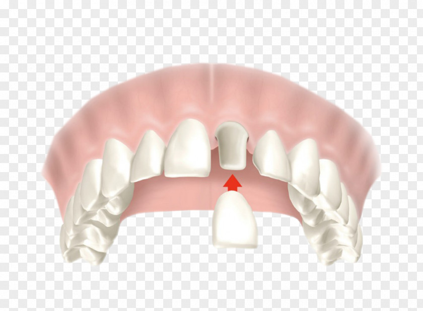 Dental Caries Crown Dentistry Bridge Restoration PNG