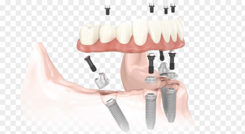Bridge All-on-4 Dental Implant Dentistry Dentures PNG