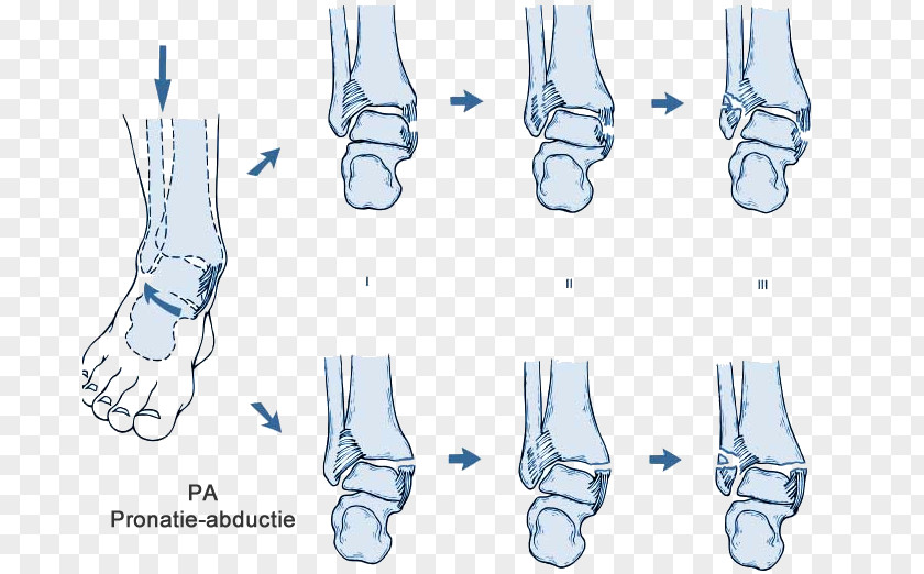 Fracture Finger Ankle Boston Celtics Shoe Foot PNG