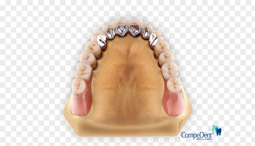 Dental Technician Tooth Laboratory Dentures Removable Partial Denture Dentallabor Klein GmbH PNG