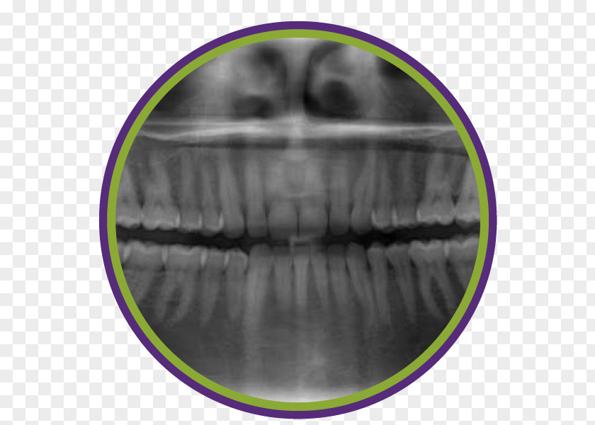 Tooth Cavity Dentistry Periodontal Disease Periodontosis Dental Radiography PNG