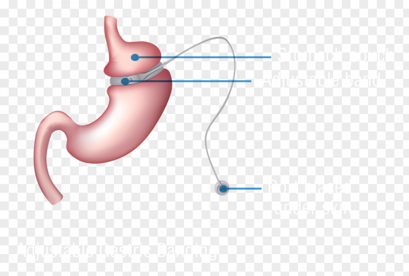 Gastric Bariatric Surgery Adjustable Band Bypass Sleeve Gastrectomy PNG