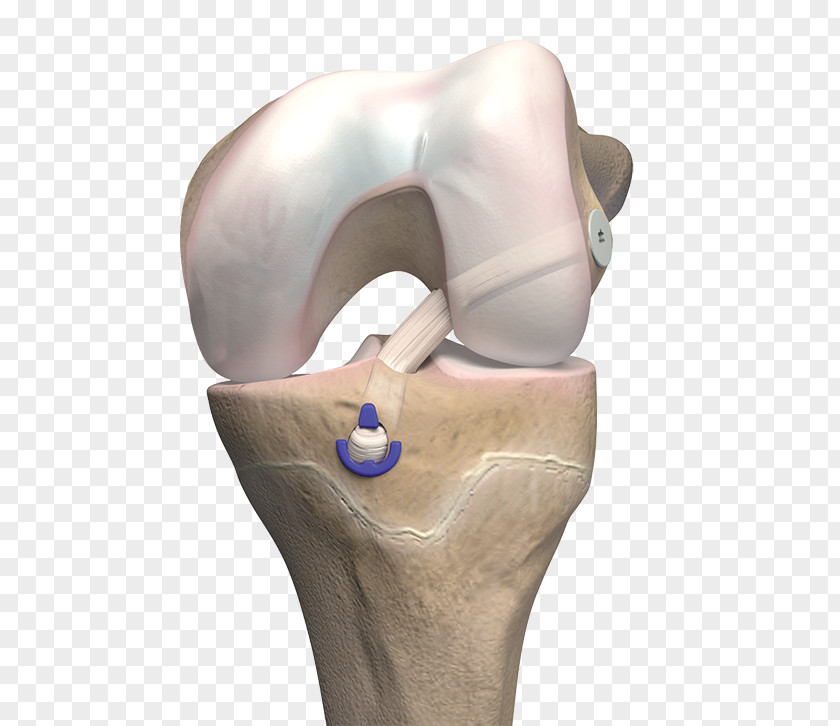 Ligament Anterior Cruciate Reconstruction Bone PNG