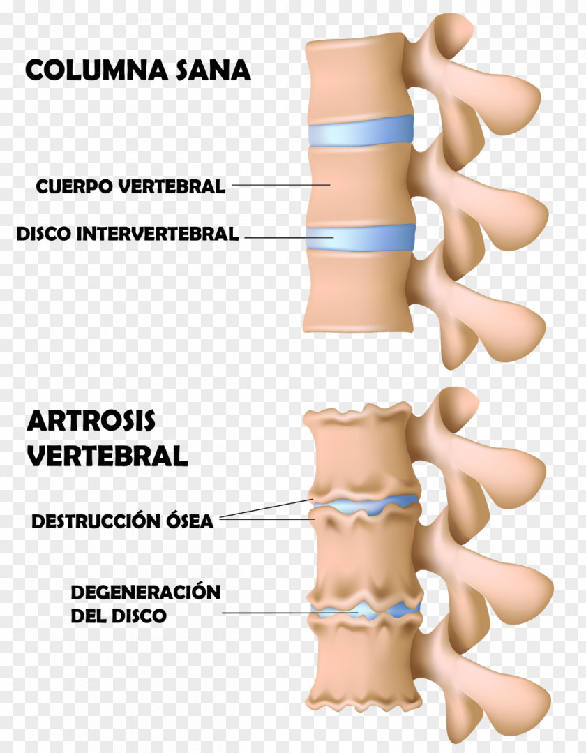 Cervical Vertebra Atlas Vertebral Column Osteophyte Osteoarthritis Bone Degenerative Disc Disease PNG