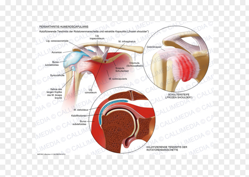 Biceps Adhesive Capsulitis Of Shoulder Periartrite Scapolo-omerale Rheumatology Joint PNG