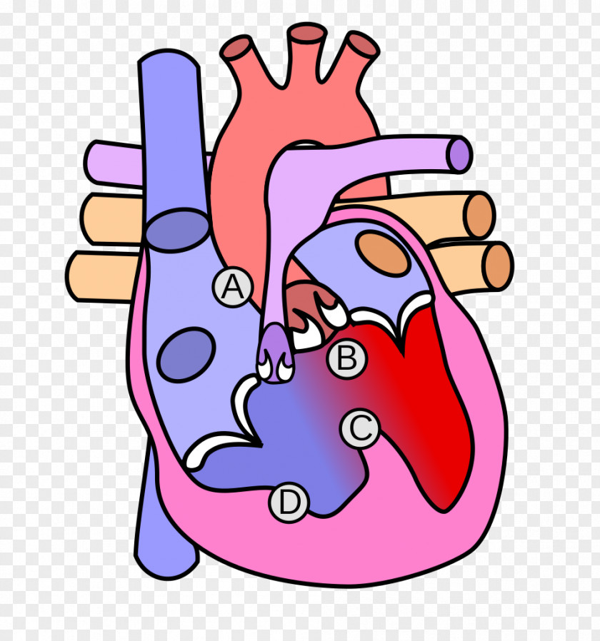 Heart Congenital Defect Aortic Valve Diagram Anatomy PNG