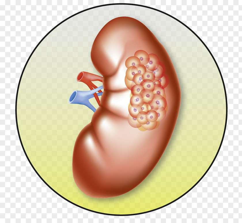 Kidney Cancer Tumour Renal Cell Carcinoma PNG
