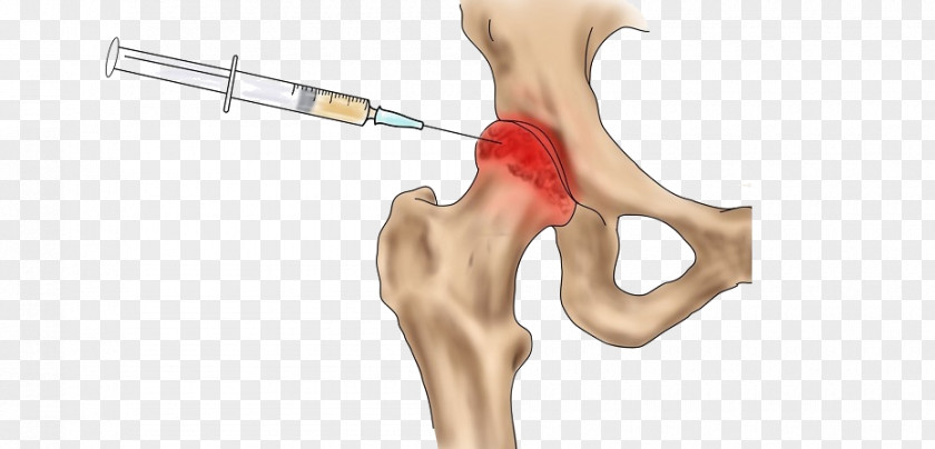 Hip Arthroscopy Bone Thumb Osteoarthritis Femur PNG