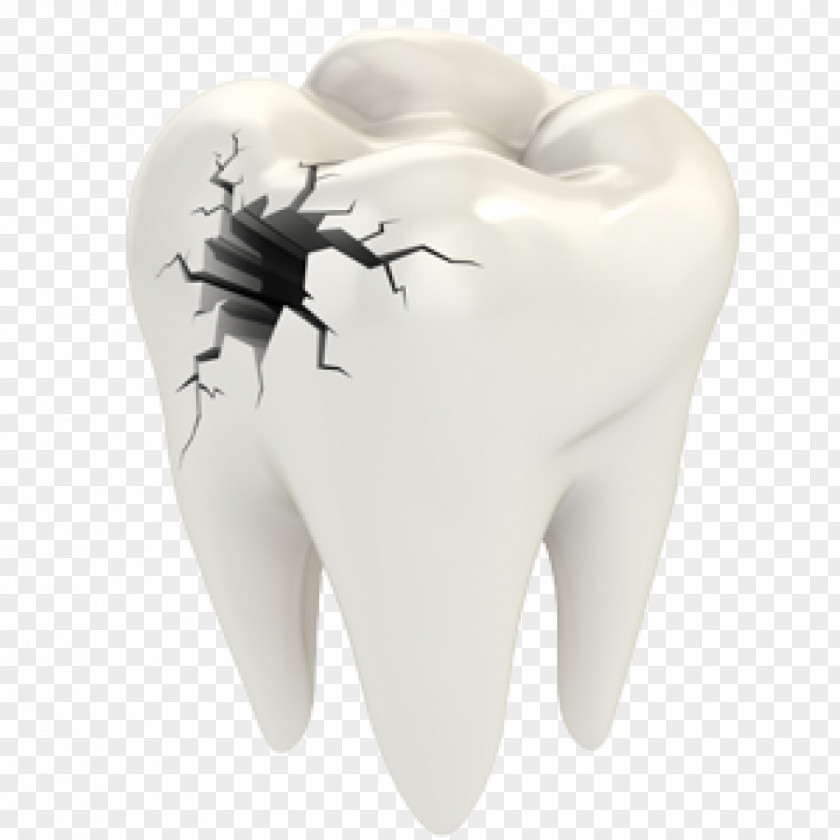 Teeth Cracked Tooth Syndrome Dentistry Dental Restoration Human PNG