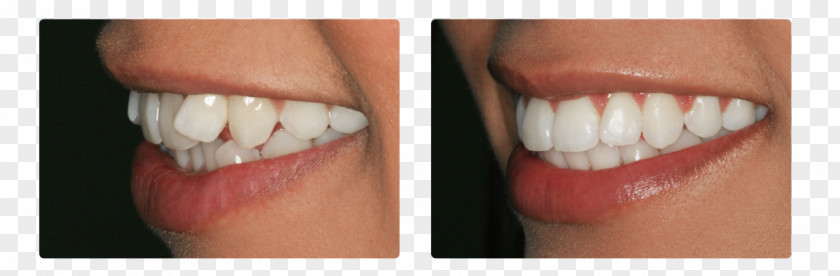 Dental Braces Tooth Cosmetic Dentistry ORDINACIJA DENTALNE MEDICINE JASNA CUPEC PNG