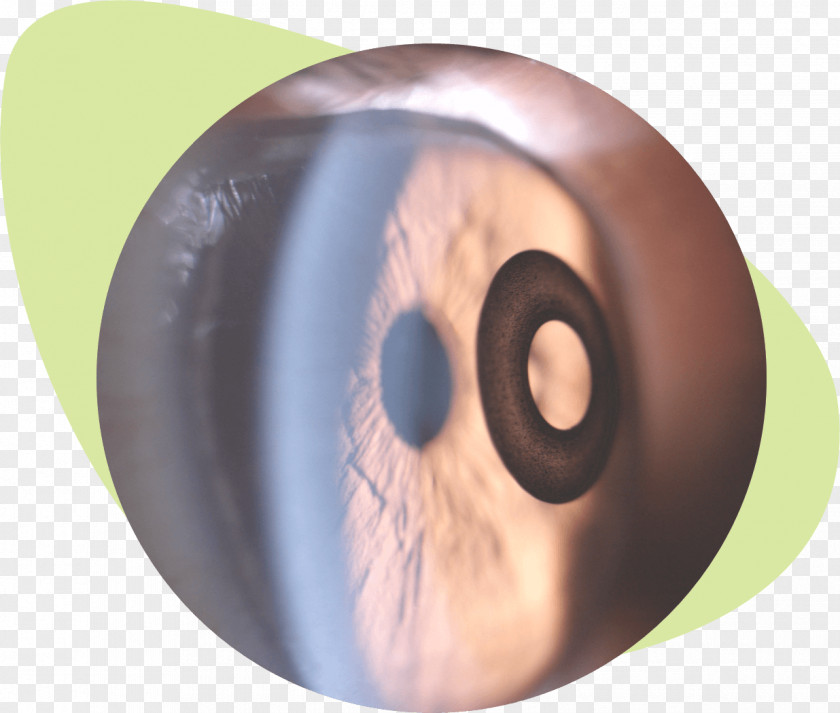 Eye KAMRA-Implantat Corneal Inlay LASIK Presbyopia PNG