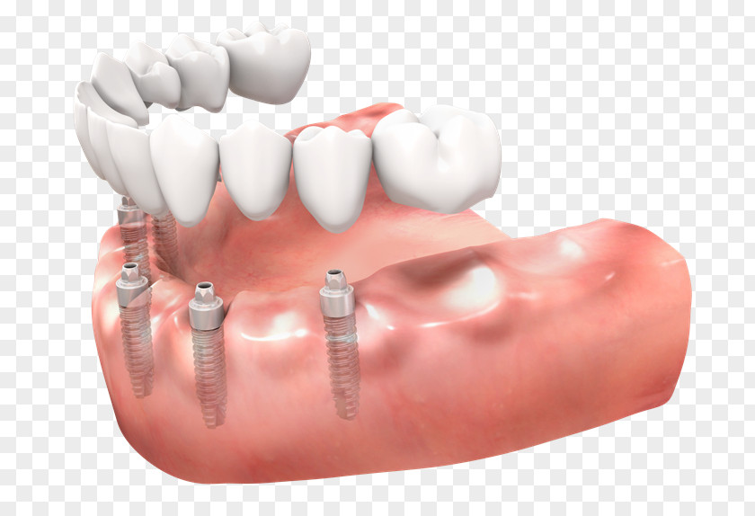 Bridge Tooth Dentures Dental Implant Implantology PNG
