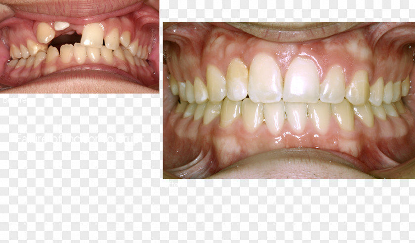 Dastrup Kent A Dds Human Tooth Dentures Close-up PNG