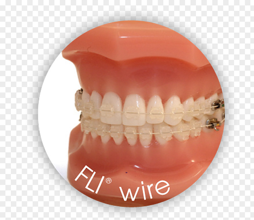 Fli Nickel Titanium Orthodontic Archwire PNG