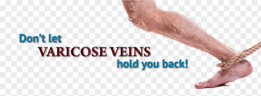 Finger Phlebitis Vein Thrombosis Human Leg PNG leg, Varicose Veins clipart PNG