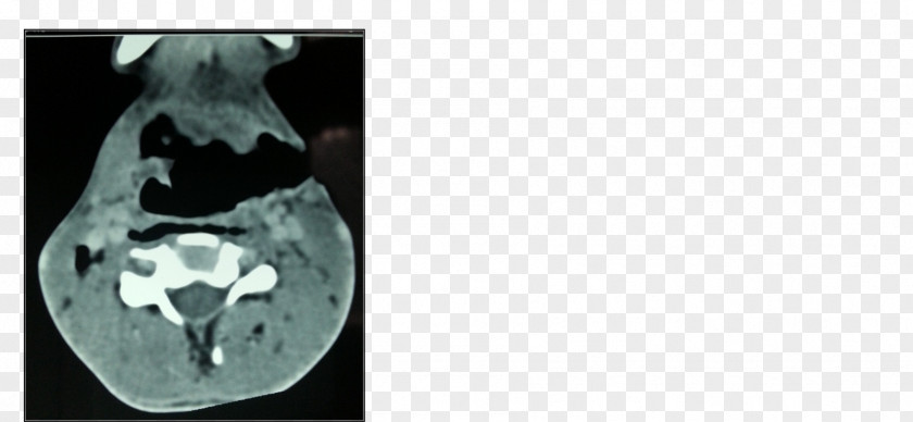 Neck Bloodstain Radiology Medical Imaging X-ray Bone Medicine PNG