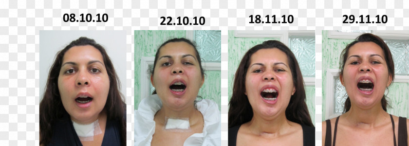 Face Chin Jaw Prótese Dentária Fixa Alaleuanluu PNG