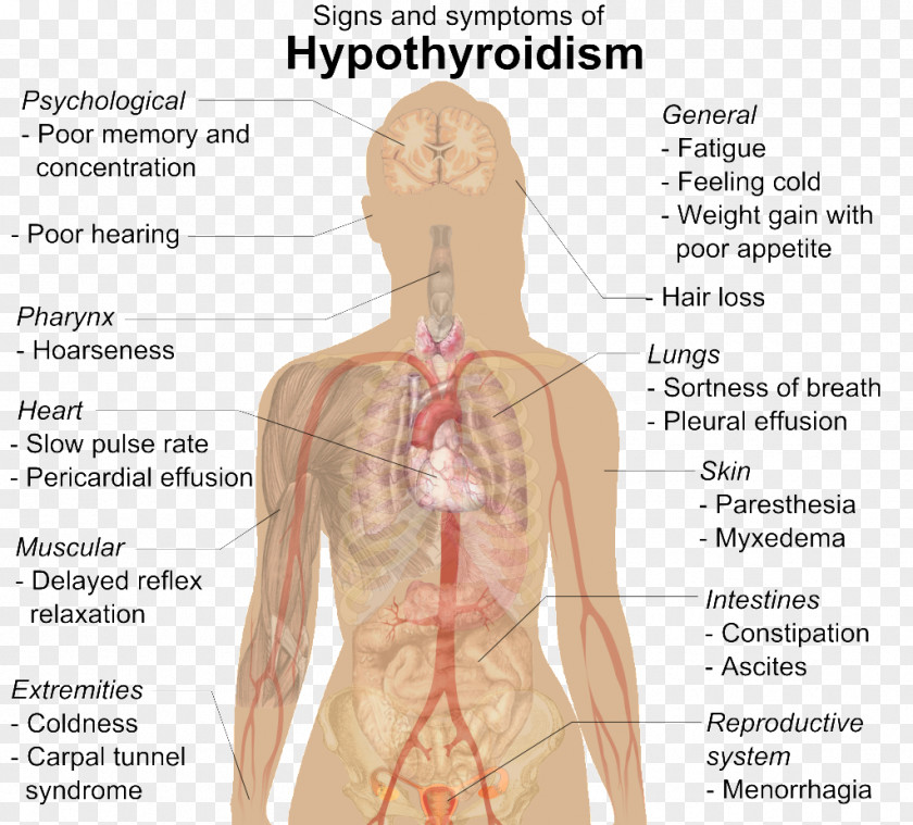 Gingival Bleeding Hypothyroidism Thyroid Disease Medical Sign Levothyroxine PNG