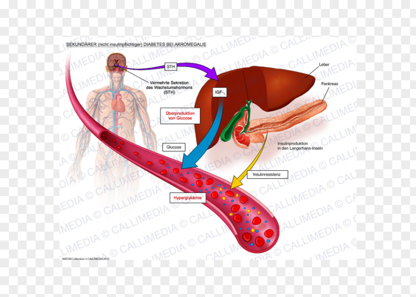 Diabetes Cartoon Mellitus Type 2 1 Insulin Acromegaly PNG