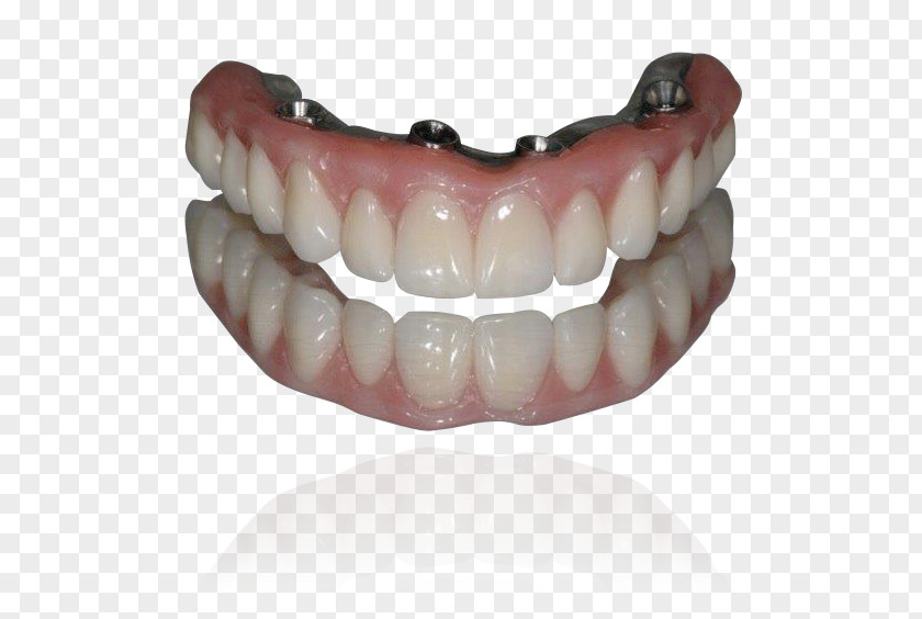 Dental Implants Tooth All-on-4 Implant Dentures PNG