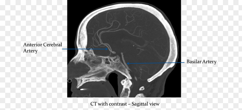 Brain Computed Tomography Circle Of Willis Sagittal Plane Intracranial Aneurysm PNG