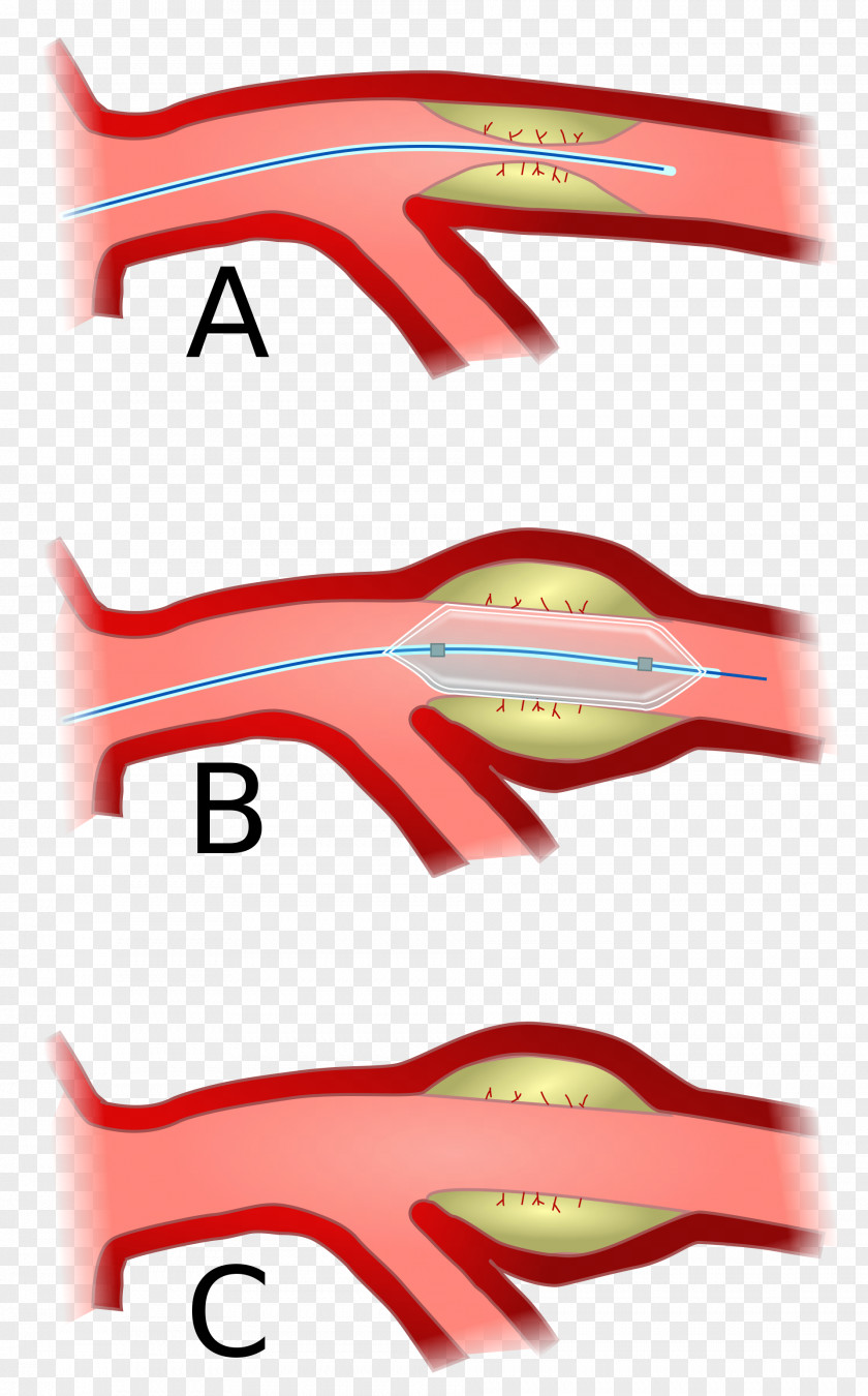 Heart Angioplasty Percutaneous Coronary Intervention Artery Disease Angina Pectoris PNG