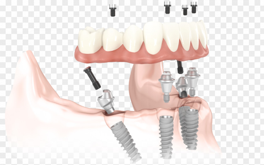 Denture All-on-4 Dental Implant Dentistry Dentures PNG