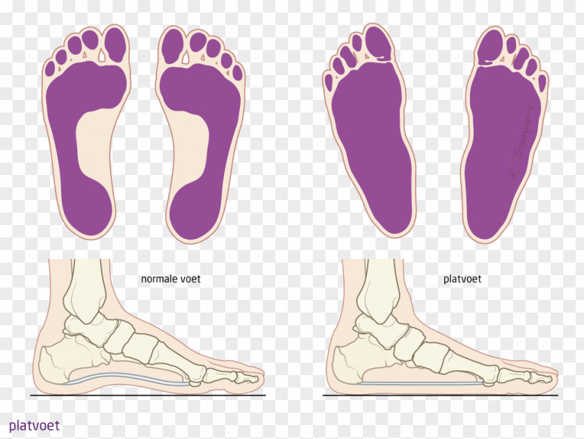 Foot Flat Feet Spreidvoet Patient Knee PNG