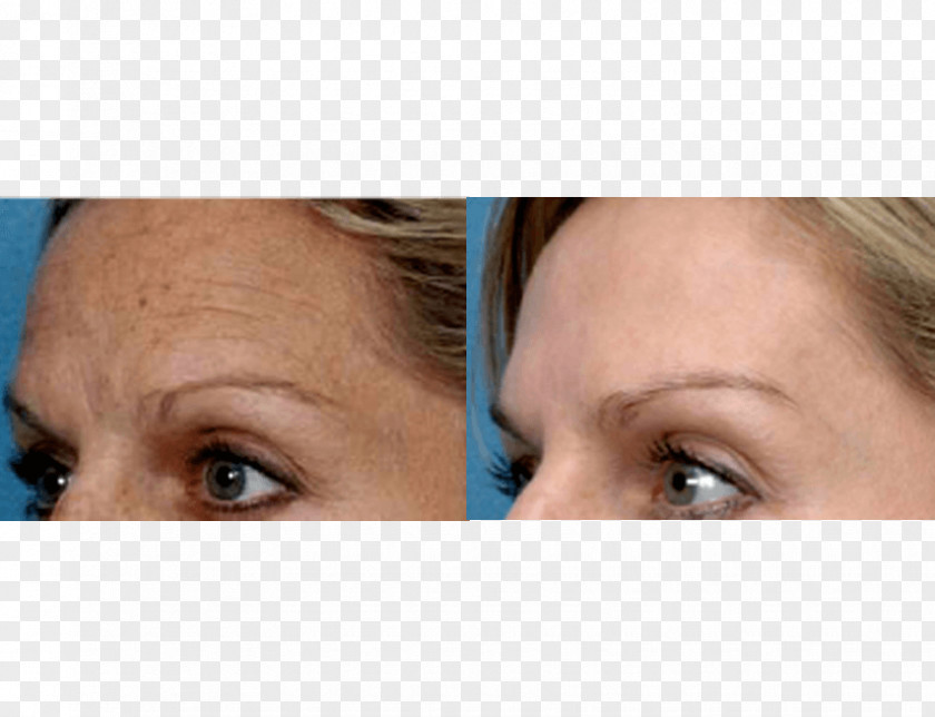 Wrinkle Photorejuvenation Facial Rejuvenation Collagen Induction Therapy Skin PNG