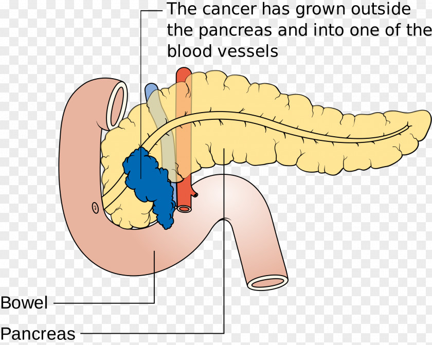Pancreatic Cancer Pancreas Disease Death PNG