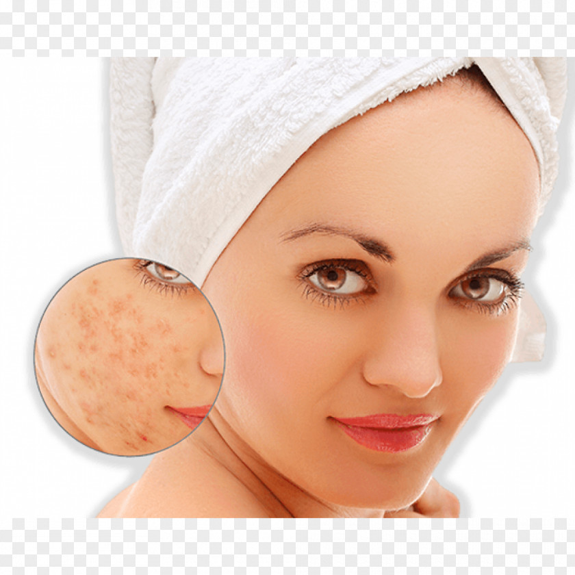 Scar Acne Pimple Dermatitis Skin PNG