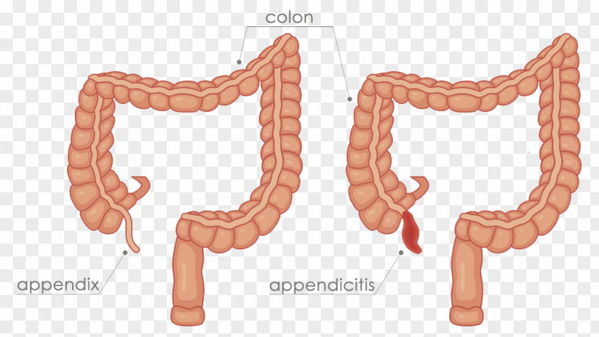 Appendix Appendicitis Appendectomy Organ Ascending Colon PNG colon, appendix clipart PNG